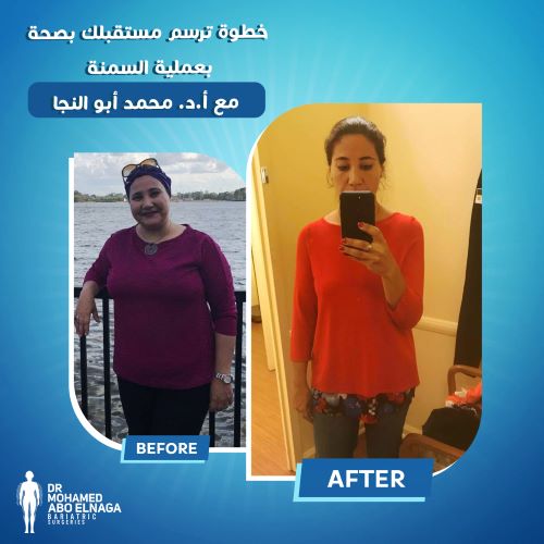 قبل وبعد عملية التكميم البكيني